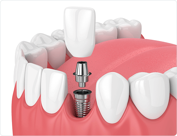 Dental Implants San Antonio, TX | Chandler Dental Center