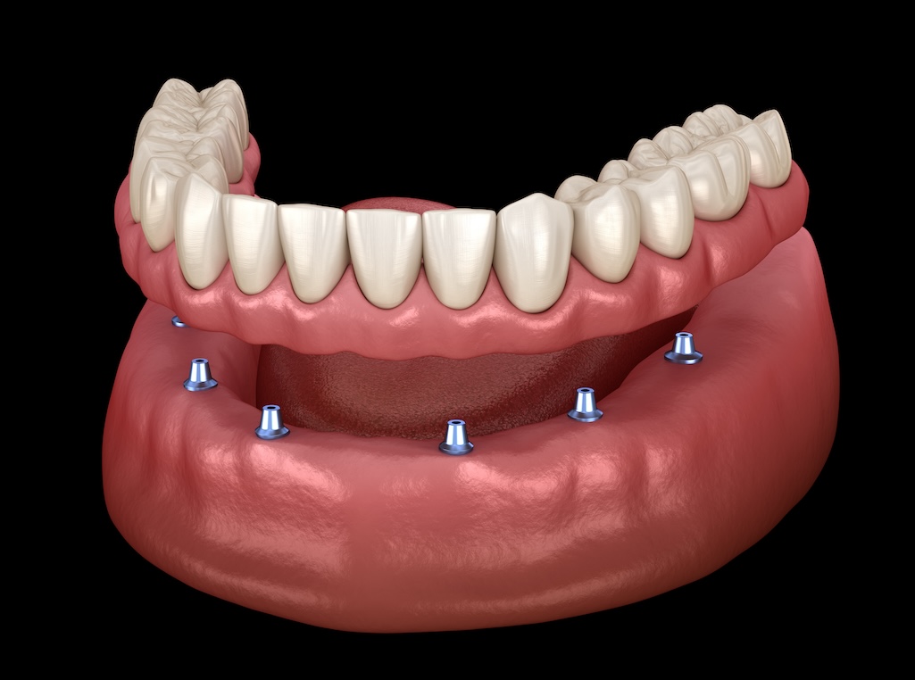 traditional dentures, implant-supported dentures, dental implants, oral health, denture stability, denture comfort, bone health, dental care